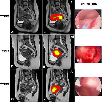 Revolutionizing hysteroscopy outcomes: AI-powered uterine myoma diagnosis algorithm shortens operation time and reduces blood loss